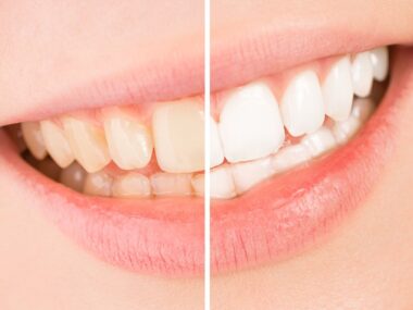 How Long to Avoid Coffee After Teeth Whitening